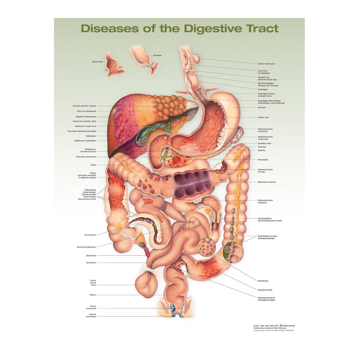 Anatomical Chart Diseases of the Digestive System, 2nd Edition 20 X 26 Inch Heavy Paper Frame / Hang Laminated - BeHope