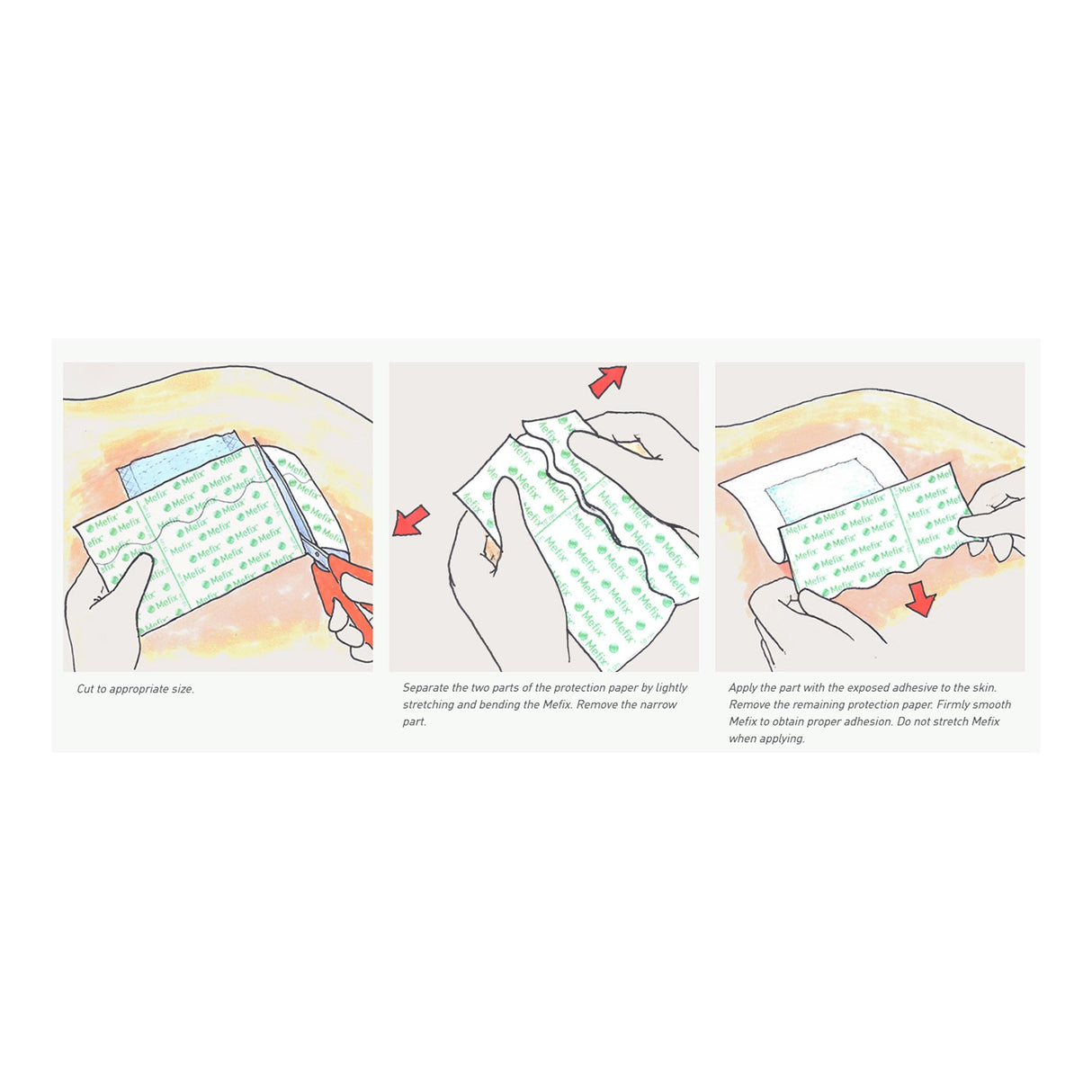 Perforated Dressing Retention Tape with Liner Mefix® White 4 Inch X 11 Yard Nonwoven Spunlace Polyester NonSterile - BeHope