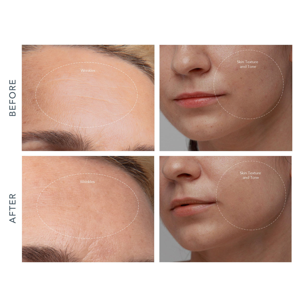 Diamond Microdermabrasion Pore Vacuum KIWI™ derma - BeHope