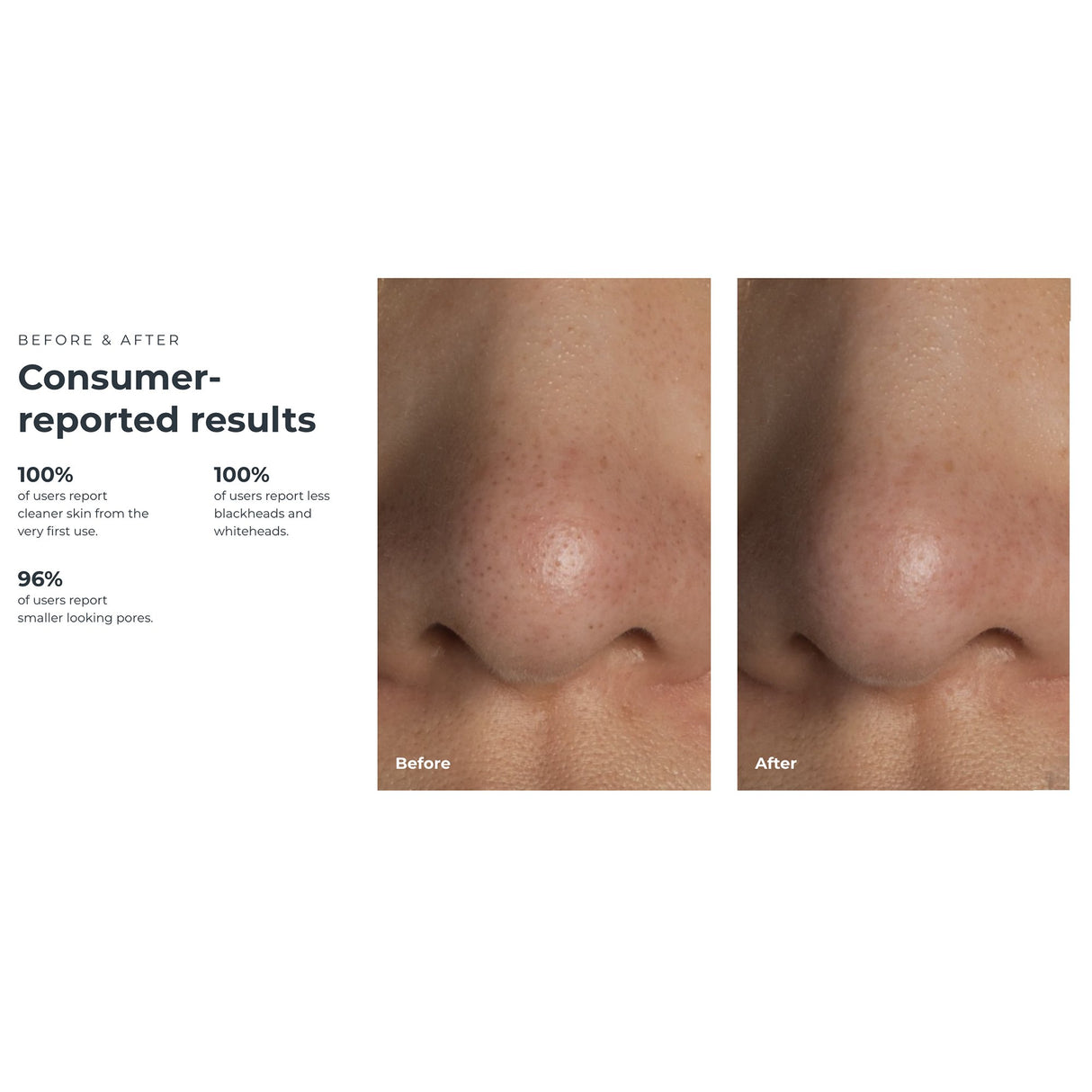 Blackhead Remover Pore Vacuum KIWI™ - BeHope