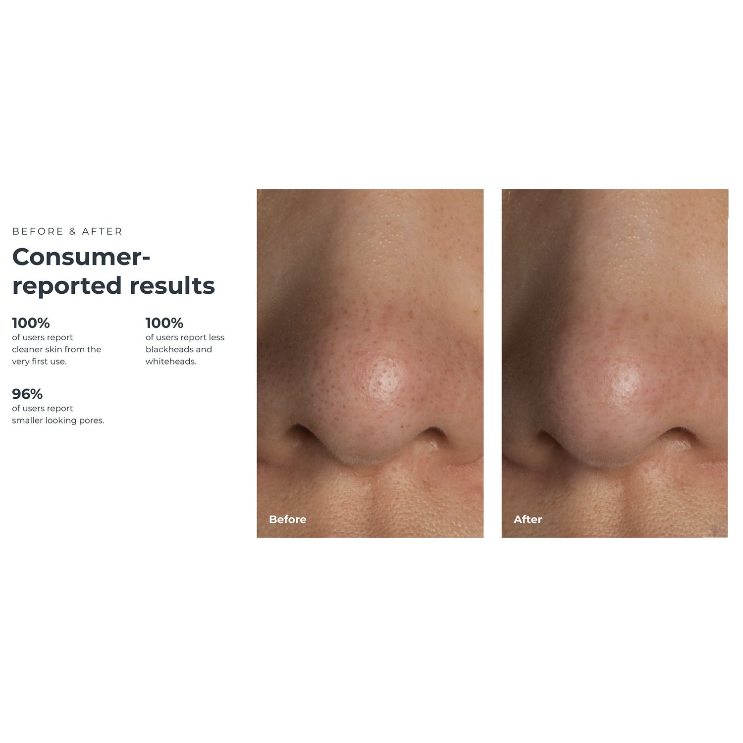 Blackhead Remover Pore Vacuum KIWI™ - BeHope