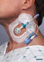 Integrated Securement Dressing Sorbaview SHIELD Fabric / Film 3-3/4 X 4-3/4 Inch Sterile - BeHope