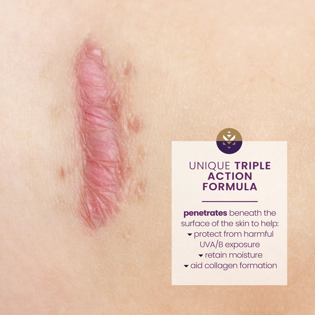 Scar Treatment with Sunscreen Mederma® Scar Cream + SPF30 20 Gram Tube Scented Cream - BeHope