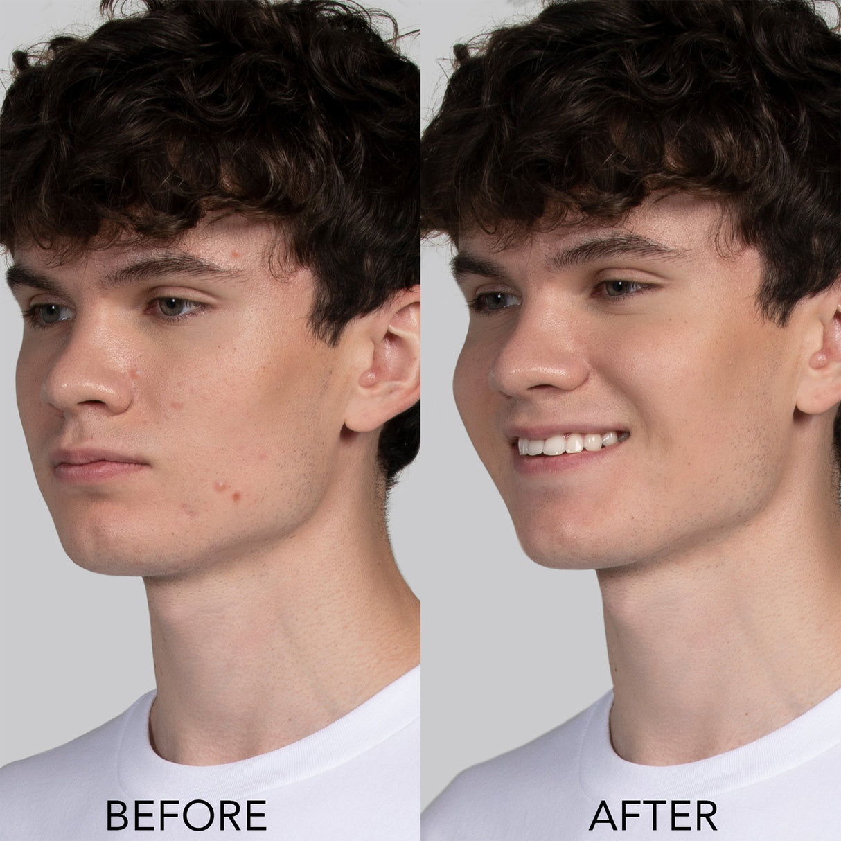 Blue LED Therapy Acne Treatment Device ESPADA™ 2 - BeHope