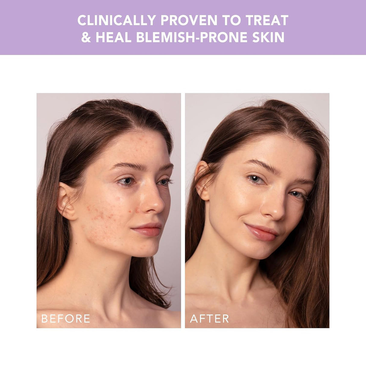 Acne Treatment ESPADA™ 2 plus - BeHope
