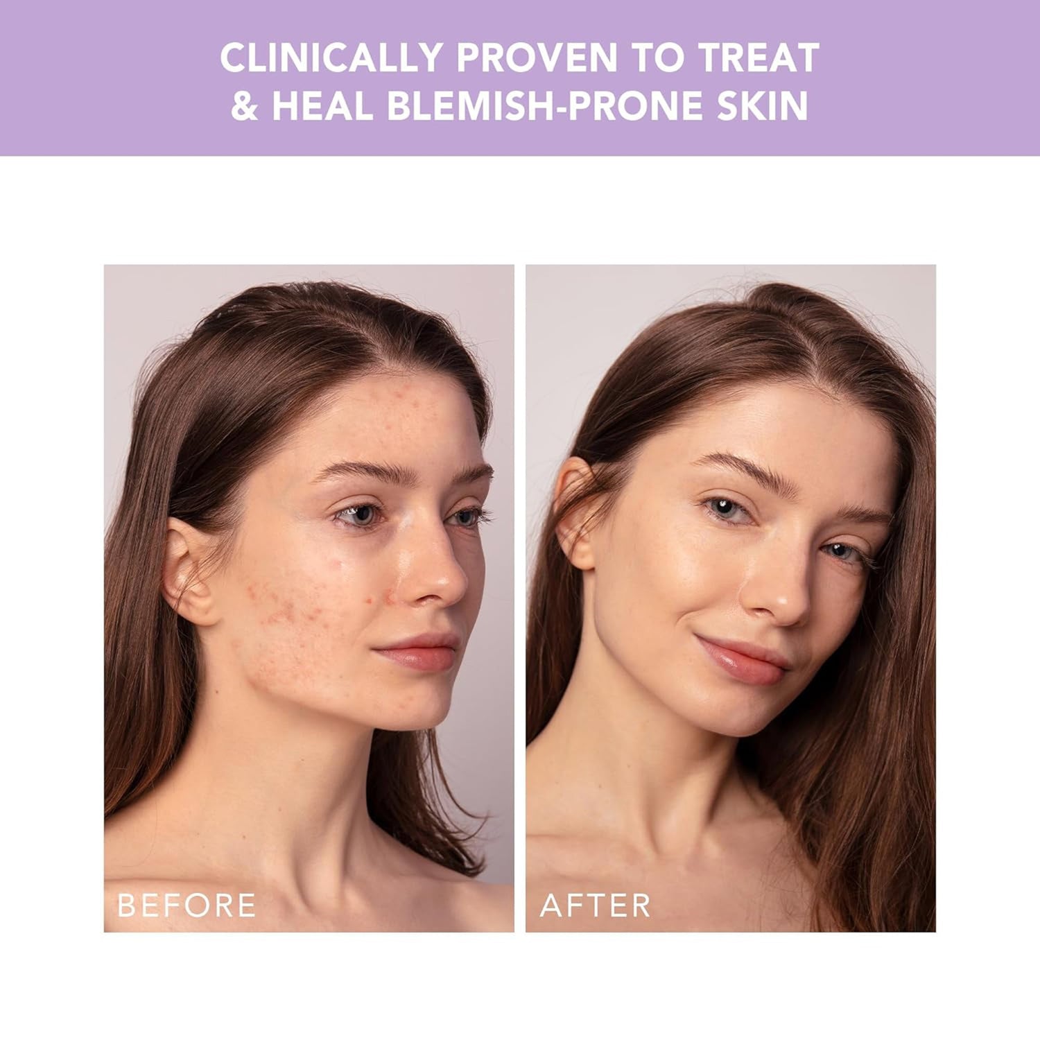 Acne Treatment ESPADA™ 2 plus - BeHope