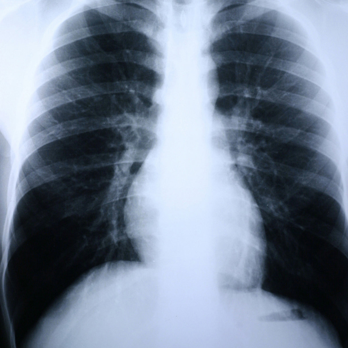 X-Ray Film Clear Choice™ Performance 8 X 10 Inch High Speed Blue Sensitive High - BeHope