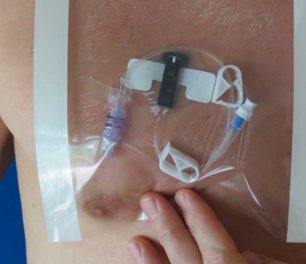 Hydroseal Waterproof Barrier for IV and Surgical Site Protection - BeHope
