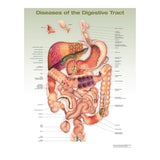 Anatomical Chart Diseases of the Digestive System, 2nd Edition 20 X 26 Inch Heavy Paper Frame / Hang Laminated - BeHope