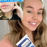 Acne Treatment PanOxyl 6 oz. Cream
