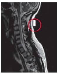 Radiology Skin Marker MRI Spee-D-Mark™ Oblong General Use - BeHope