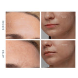 Diamond Microdermabrasion Pore Vacuum KIWI derma