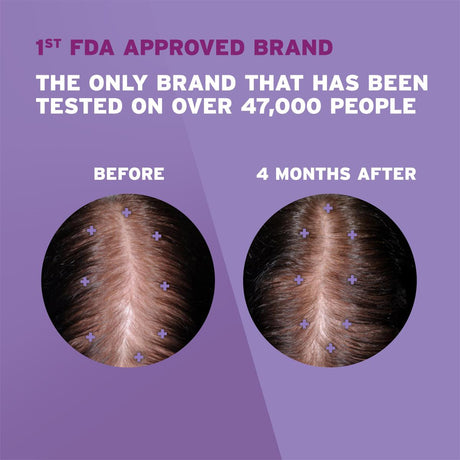Women's Rogaine 2% Minoxidil Solution - BeHope
