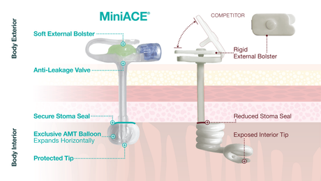 Antegrade Enema Miniace® Enfit Button with Secure Stoma Seal Anti-Leakage Valve - BeHope
