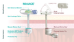 Miniace® Antegrade Enema Low Profile Button with Anti-Leak Valve - BeHope