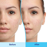 Acne Treatment Differin 45 Gram Gel