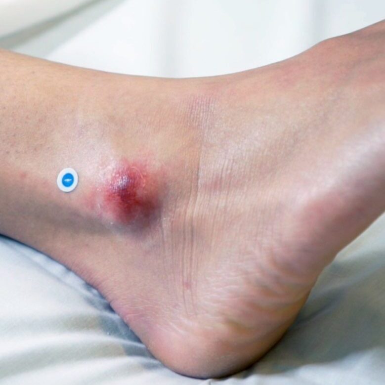HealX Scientific Calibrant for Wound Imaging - BeHope