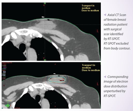 Radiology Skin Marker D-spot® Arrow Simulation - Behope